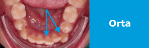 Ortodonti Tedavisi Fiyatları: orta zorluk 2-5 mm