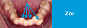Ortodonti Tedavisi Fiyatları: zor vaka >5 mm