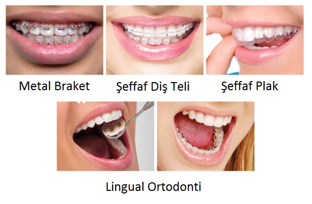 Şeffaf Diş Teli vs Şeffaf Plak vs Lingual Ortodonti