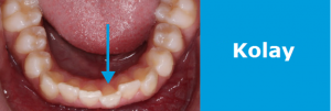 Ortodonti Tedavisi Fiyatları: Basit 0-2 mm